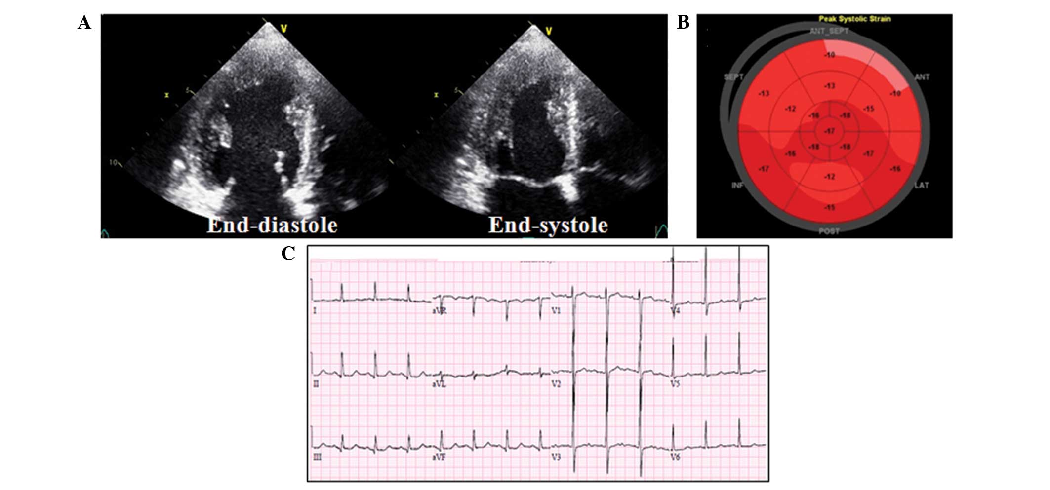 Transient severe left ventricular dysfunction following percutaneous patent ductus arteriosus ...