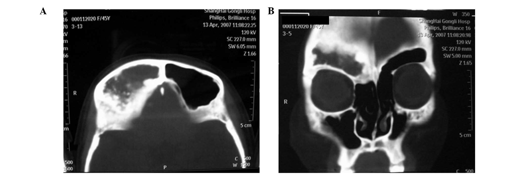 A case of ossifying fibroma of the frontal sinus