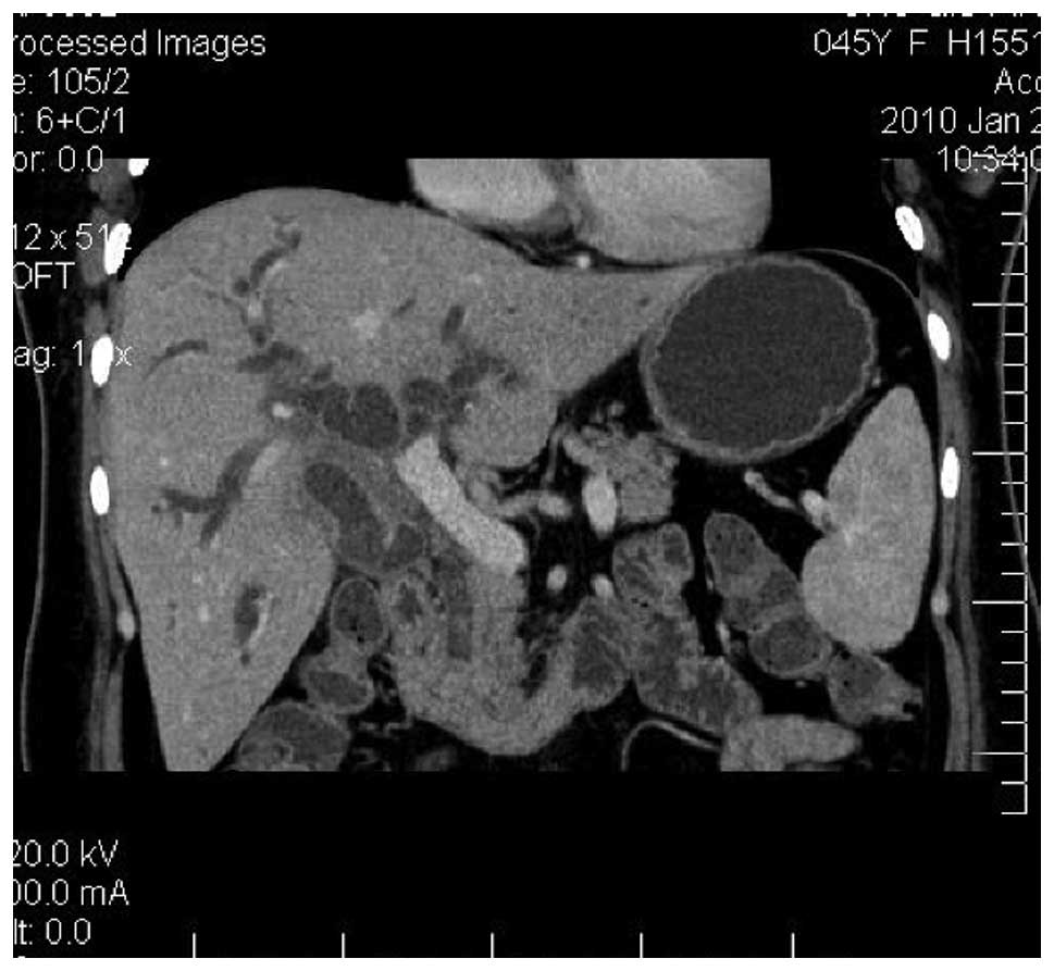 Reconstruction of the portal vein with 64-slice spiral CT of bile duct