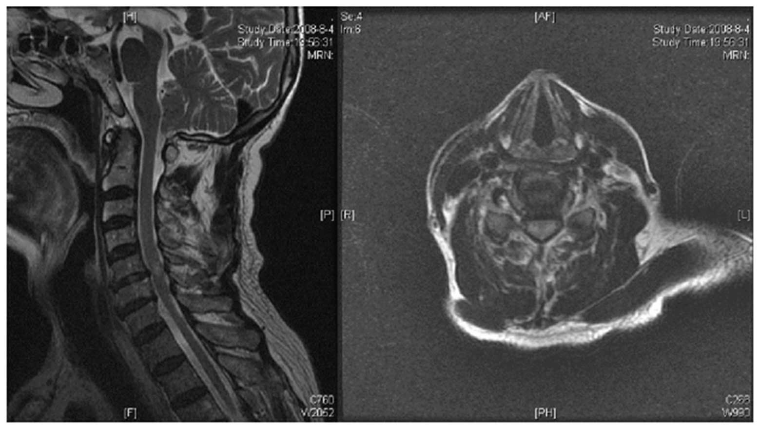 Cervical spondylotic myelopathy with vitamin B12 deficiency: Two case