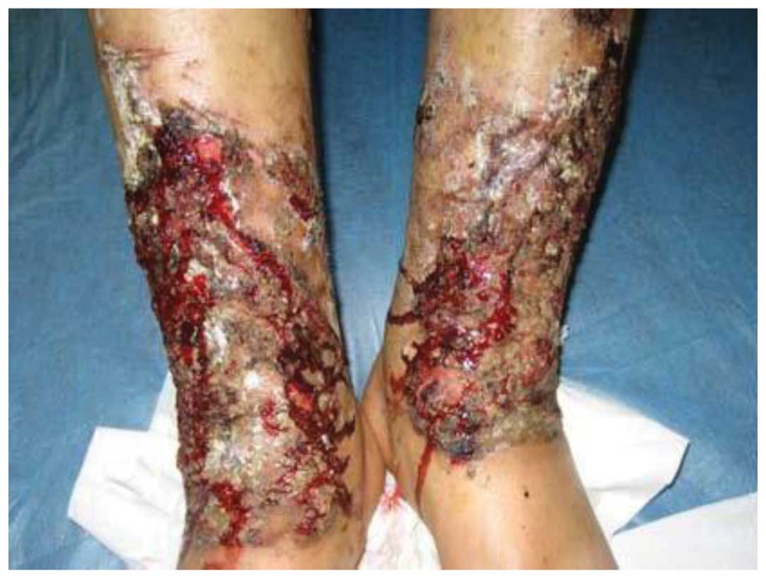 Chemical burns - WebMD Boots