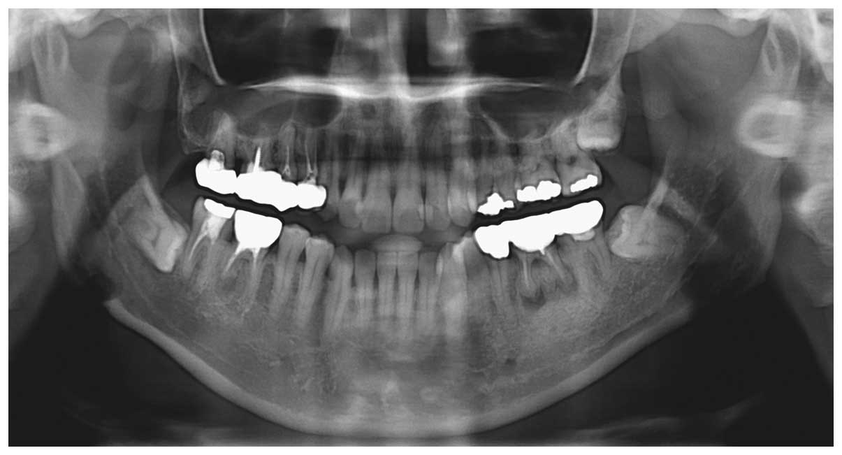 A large sialolith on the parenchyma of the submandibular gland: A case