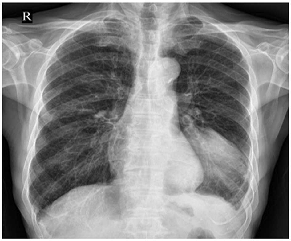 Primary malignant melanoma of left lower lobe of lung: A case report