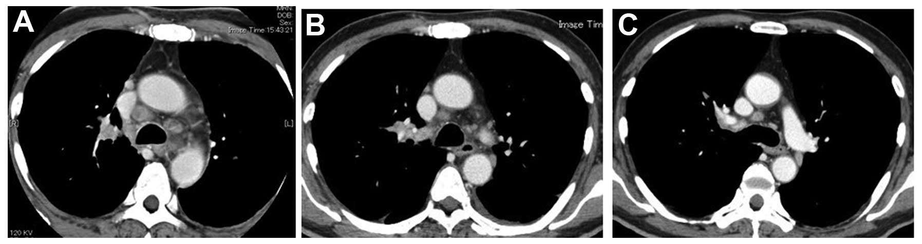 Lung Cancer With Spontaneous Regression Of Primary And Metastatic Sites