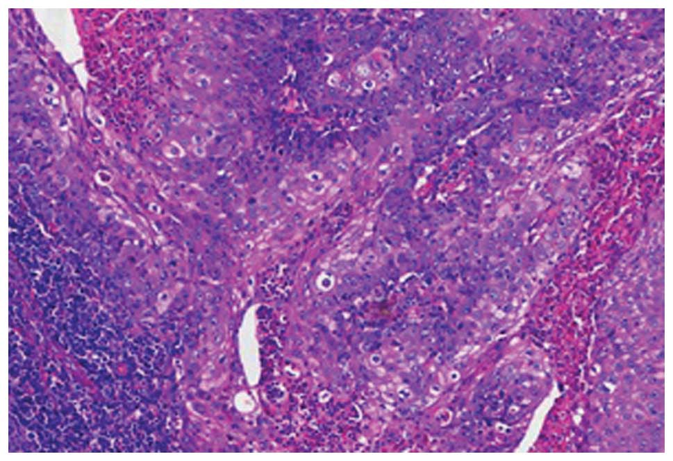 Squamous cell carcinoma of unknown primary site presenting with an