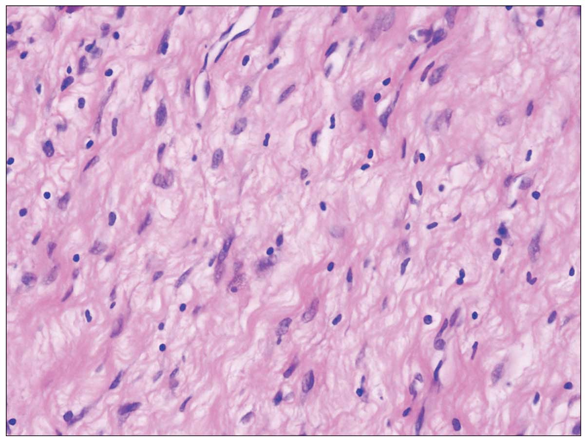 Desmoplastic fibroma in the proximal femur: A case report with long