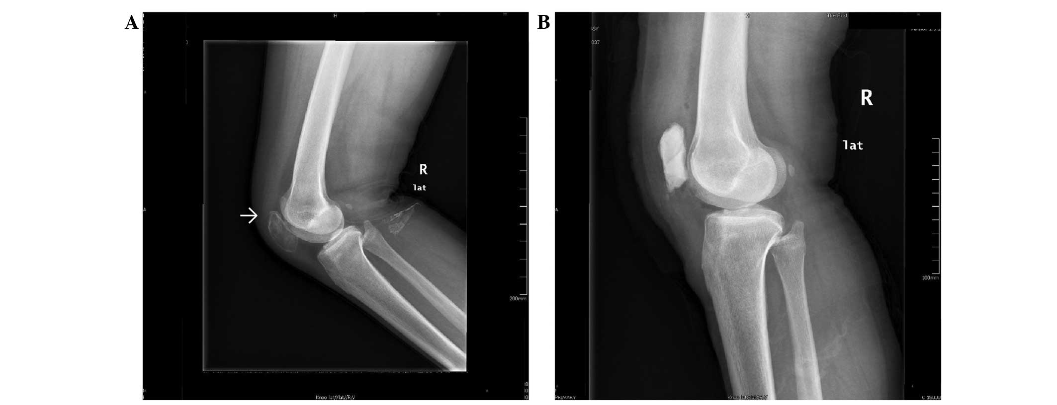 Aneurysmal bone cyst secondary to a giant cell tumor of the patella: A