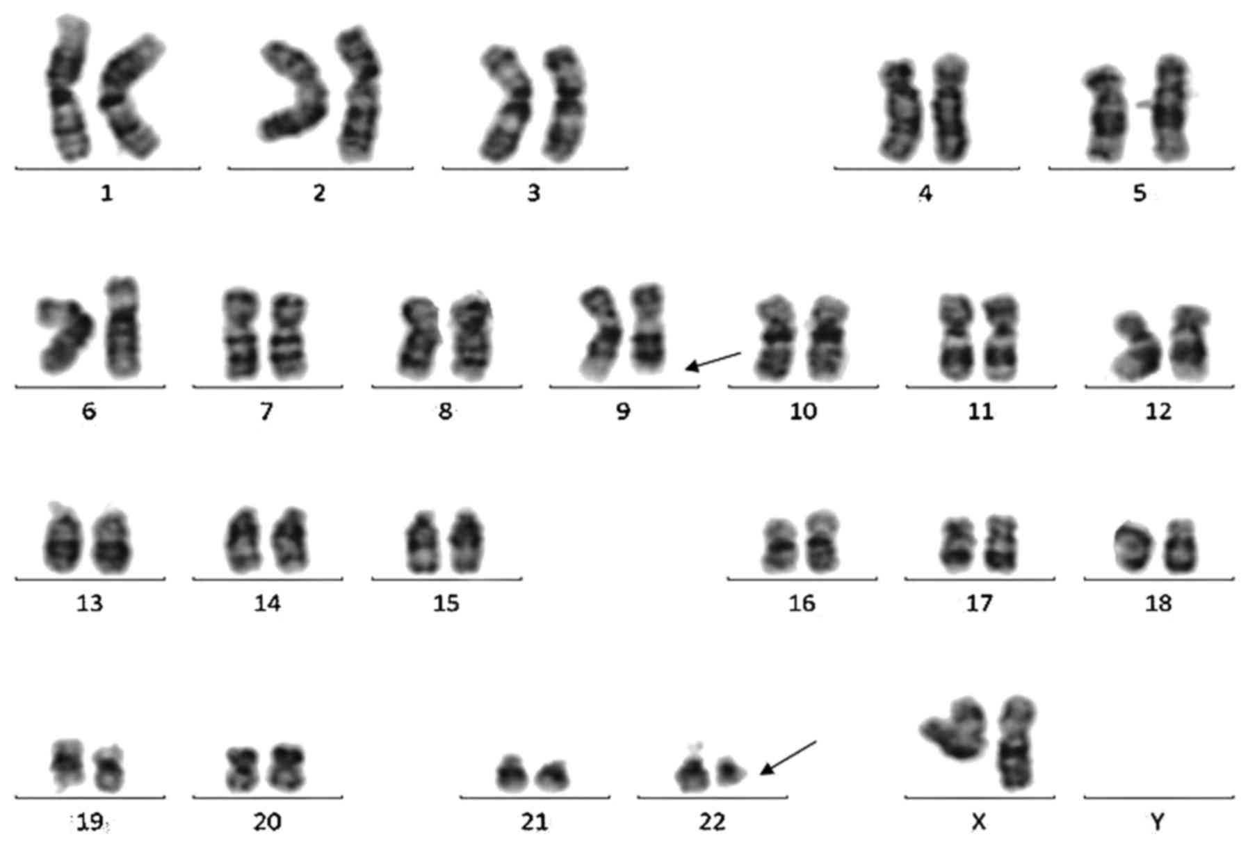 Philadelphia Chromosome With Acute Myeloid Leukemia And Concurrent Large B Cell Lymphoma Of 