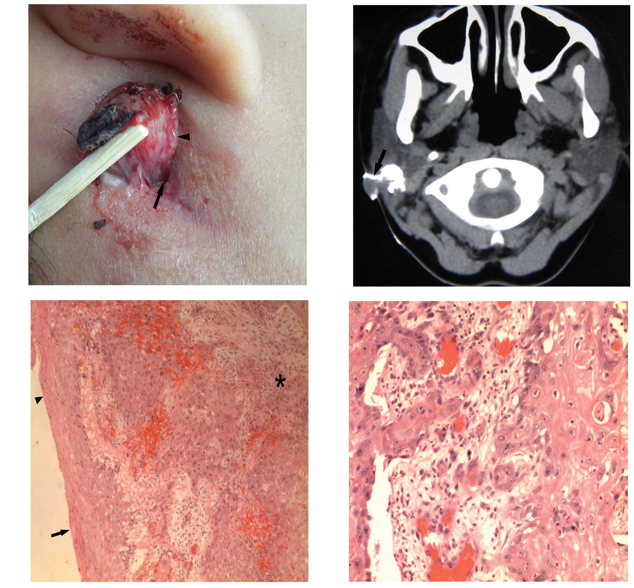 Swollen Lymph Nodes Behind Ear Lump Behind Ear | Rachael Edwards