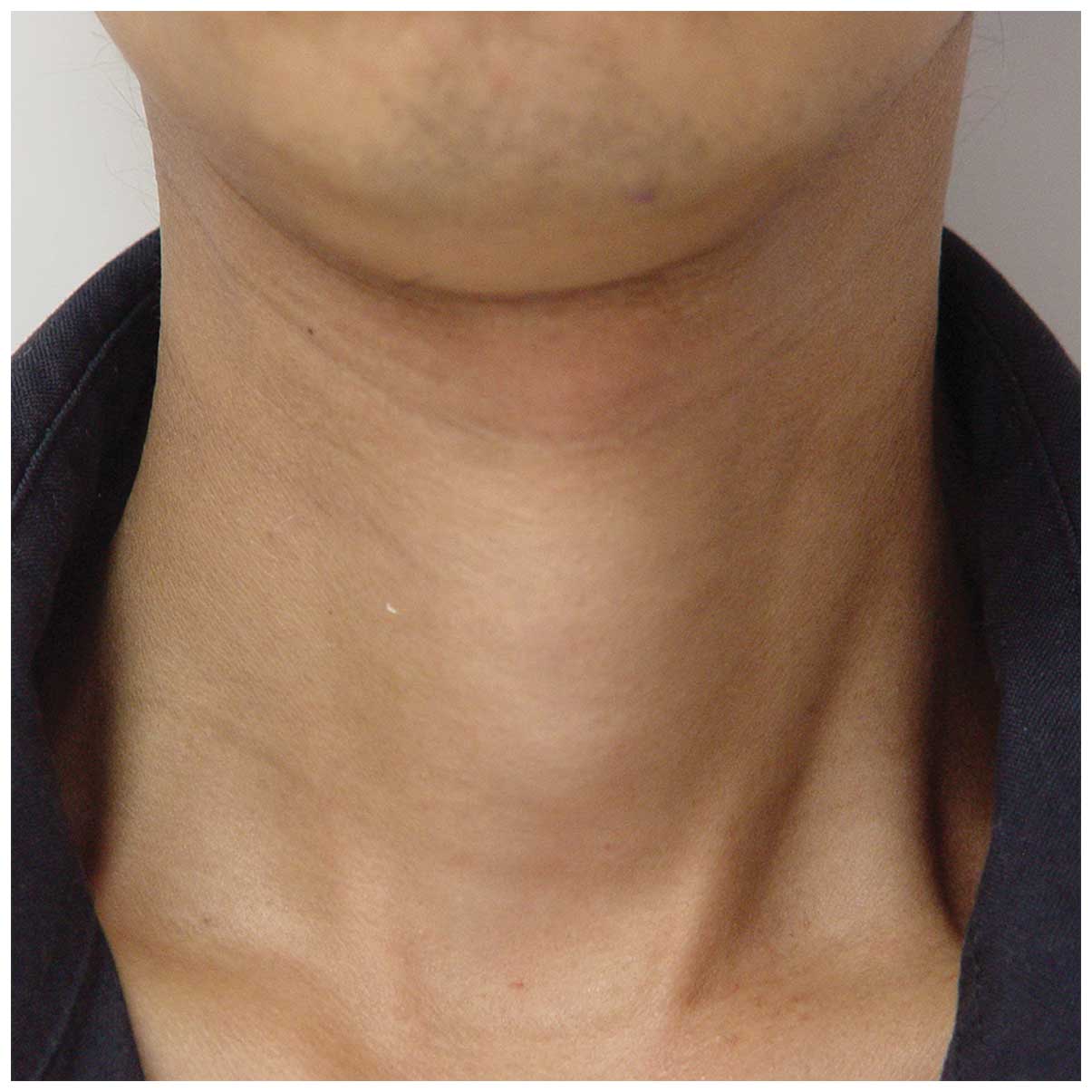 Human Gland In Neck