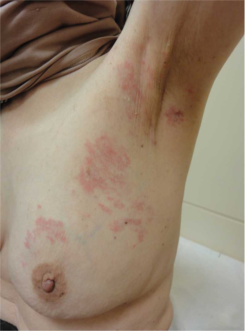 Red Neck Rash Causes and Pictures | Healthhype.com