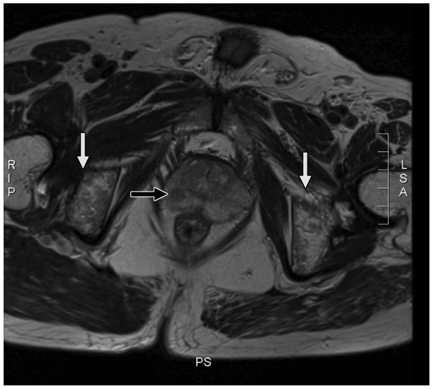 Prostatic metastases and polycythemia vera on bone magnetic resonance