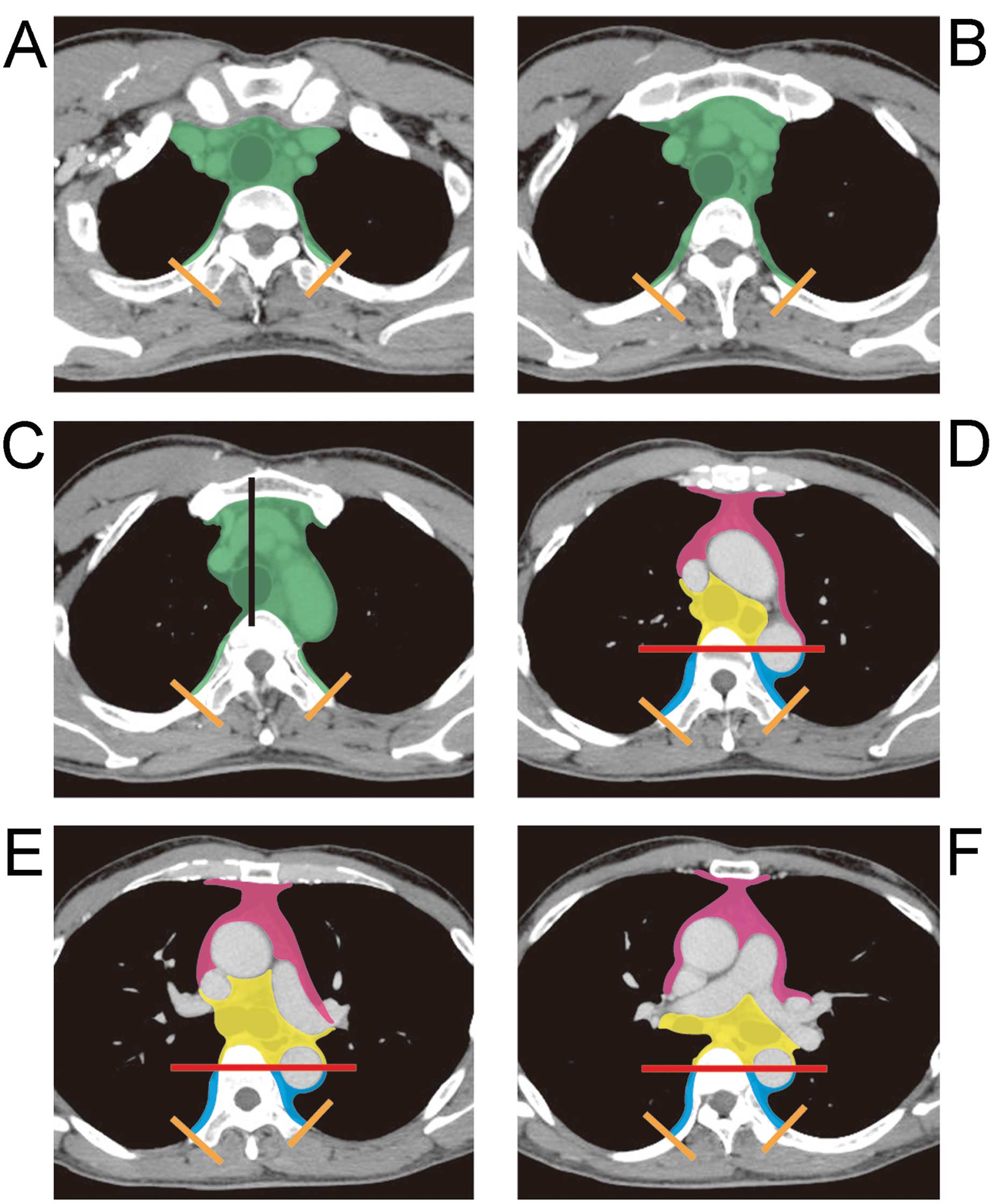 Proposal for a new mediastinal compartment classification of transverse
