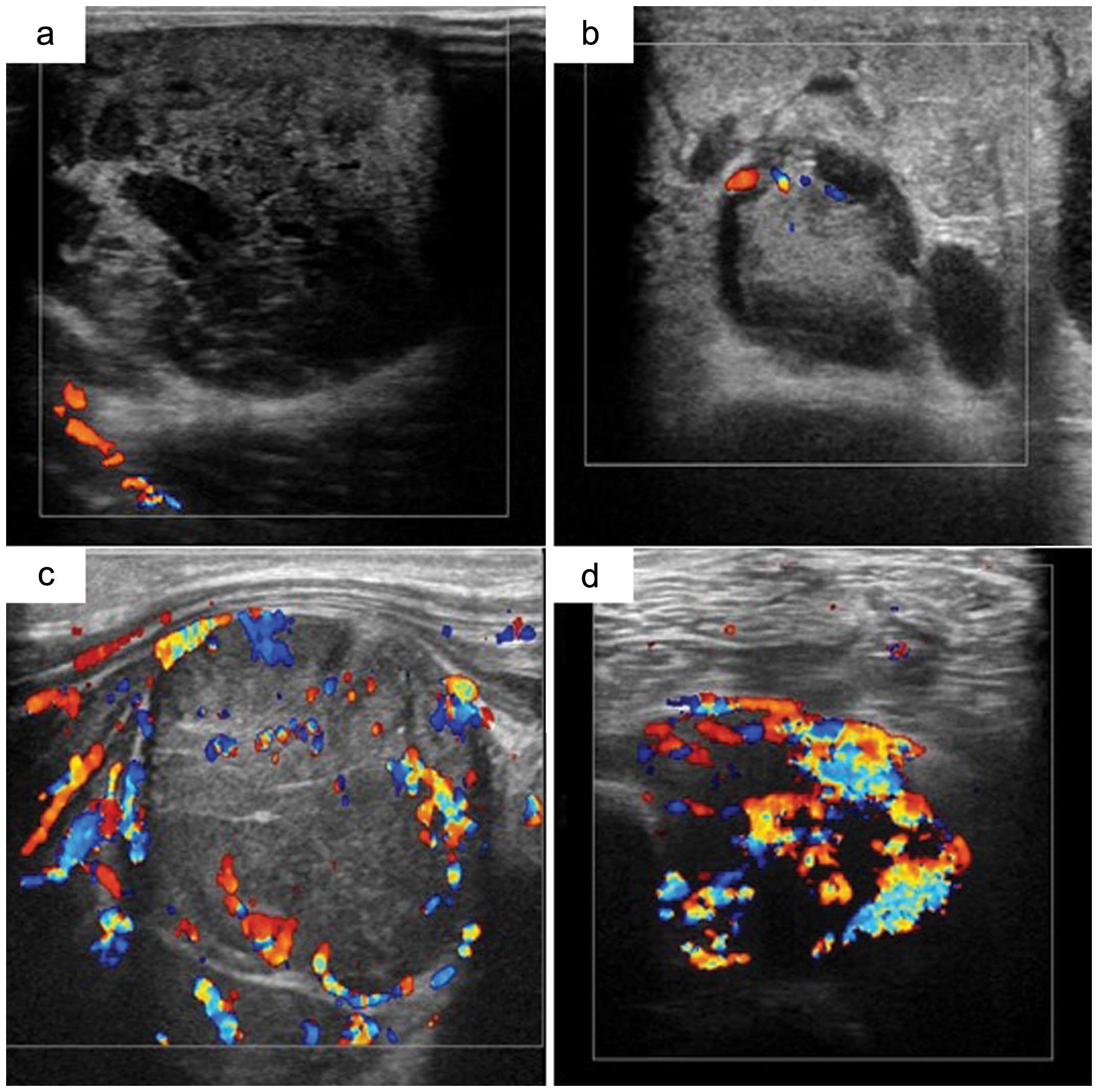 Contrast-enhanced color Doppler ultrasonography increases diagnostic