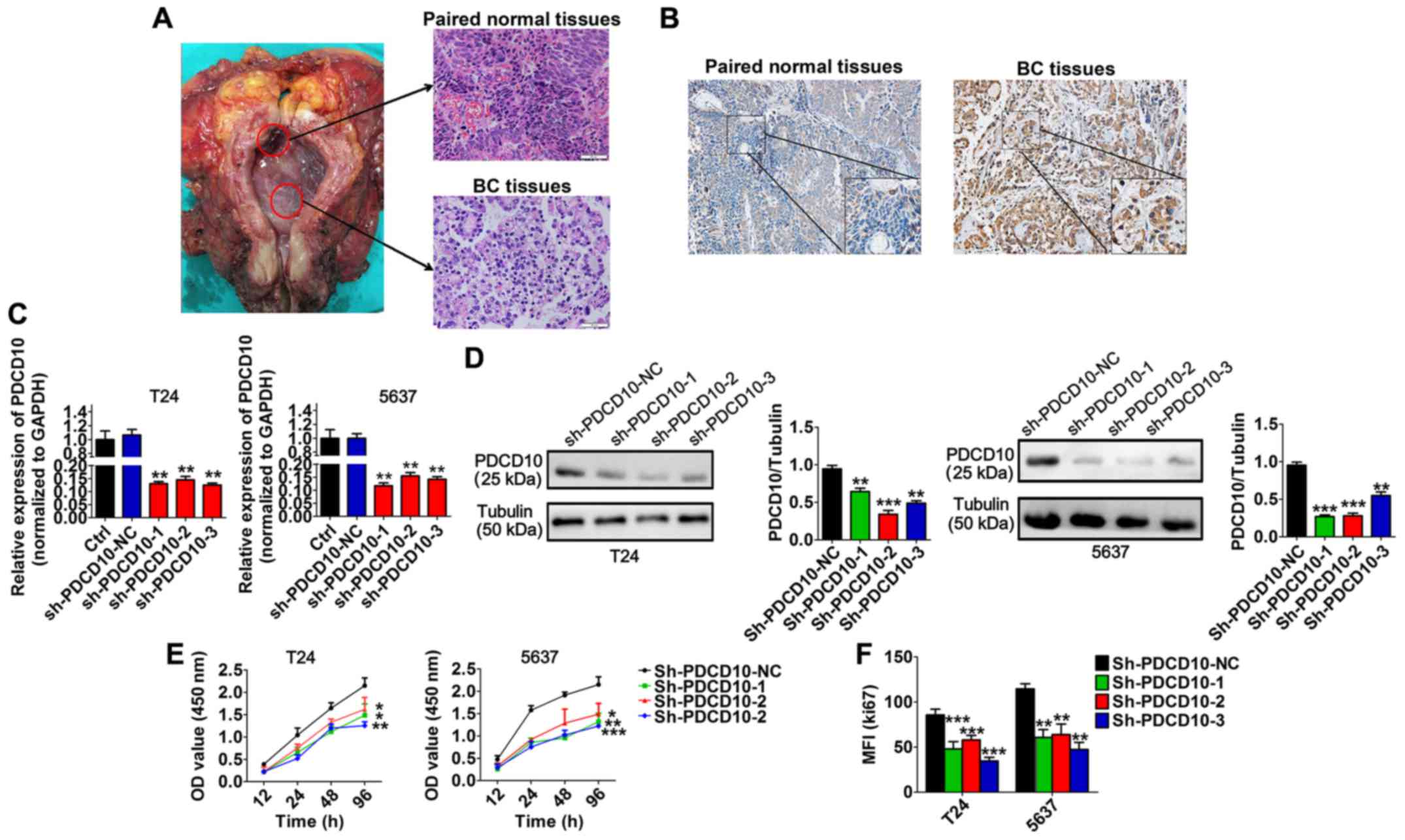 MicroRNA-155 promotes bladder cancer growth by repressing 