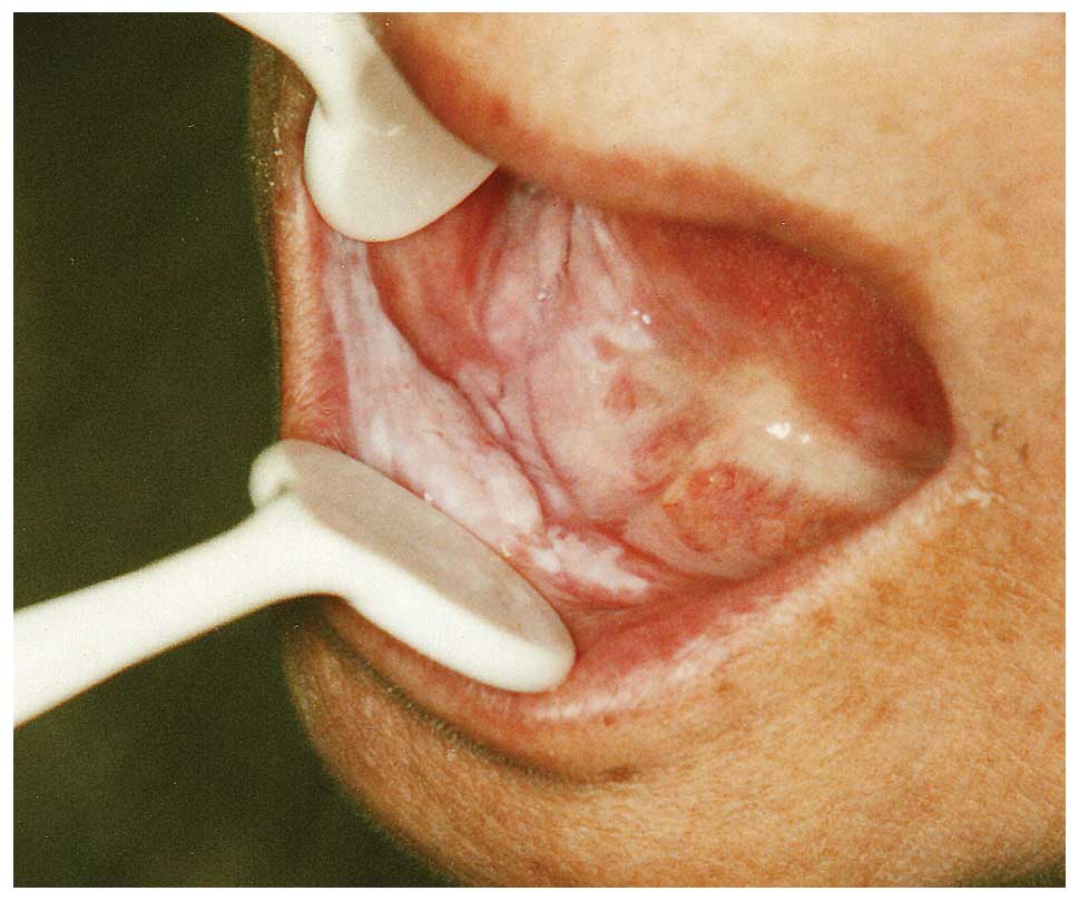 verrucous carcinoma palate