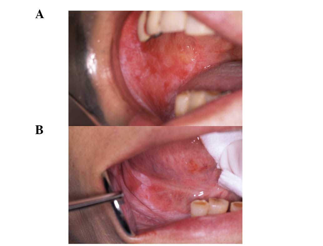 verrucous carcinoma palate