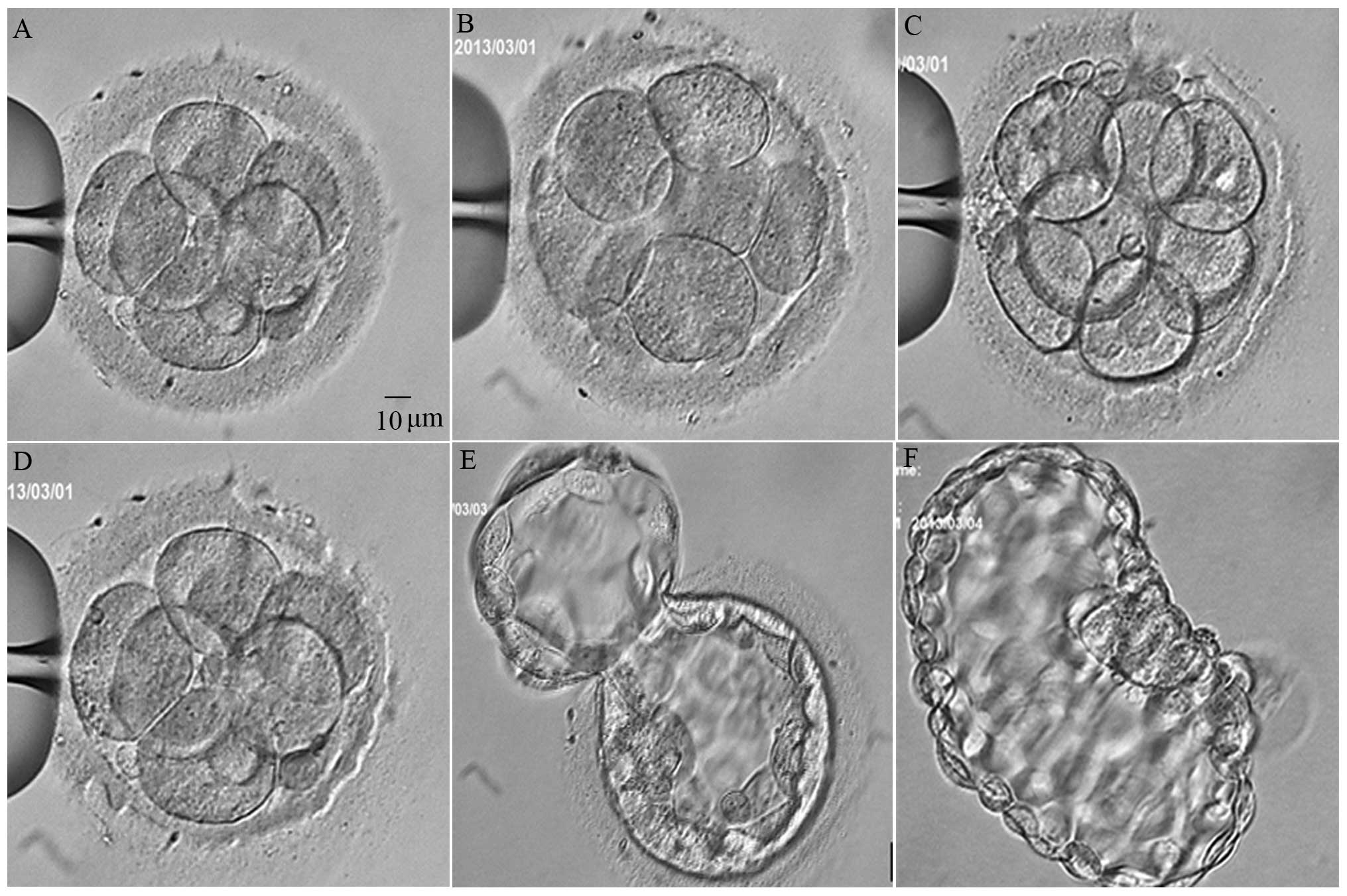 Outcomes of cleavage-stage embryo hatching after in vitro laser-assisted zona pellucida thinning in patients