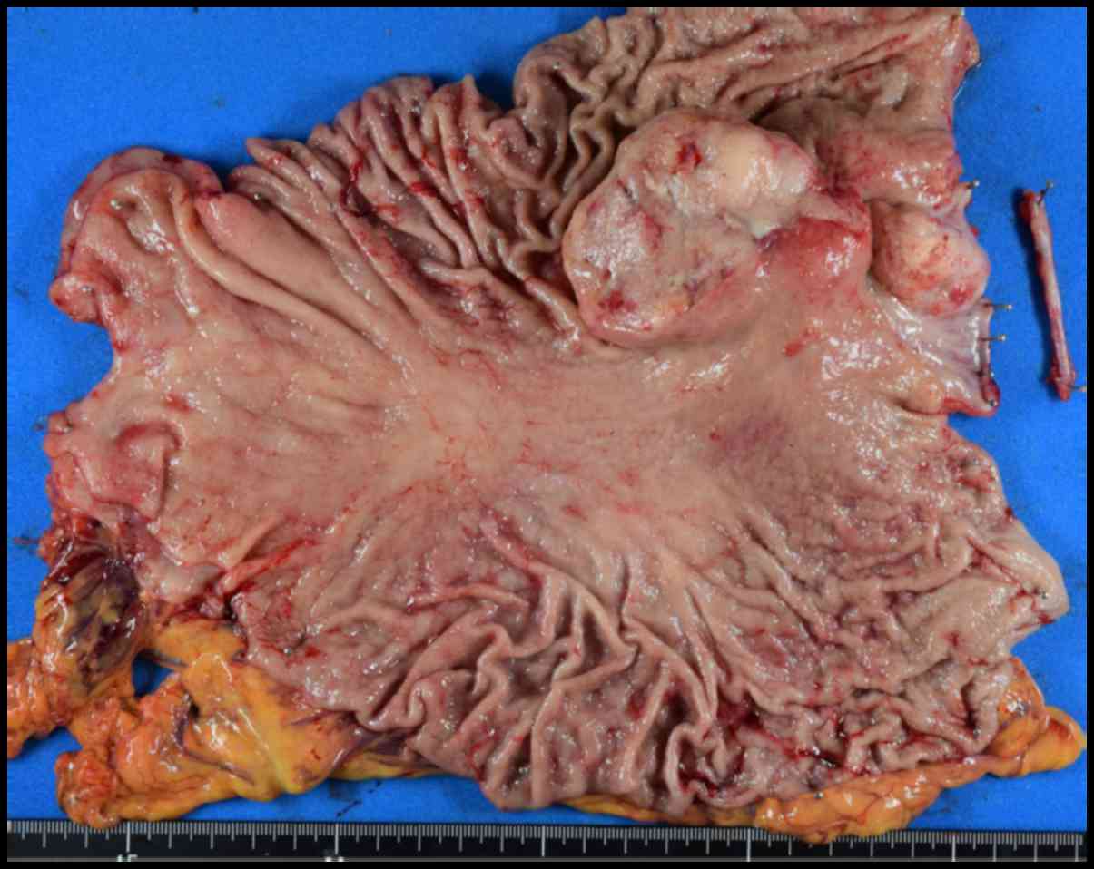 metastatic cancer from gastric)