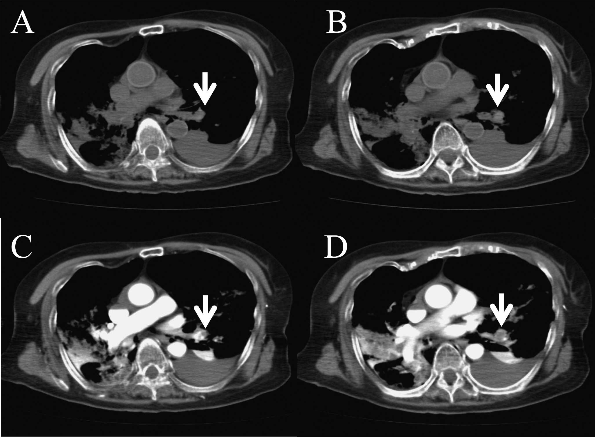 Post Mortem Contrast Enhanced Computed Tomography In A Case Of Sudden