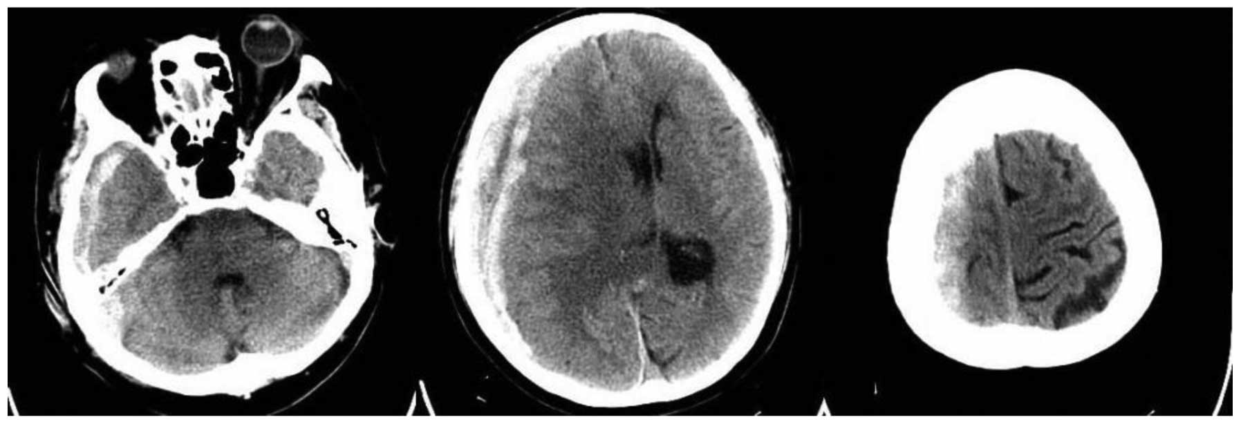 Acute on chronic subdural hematoma case report examples