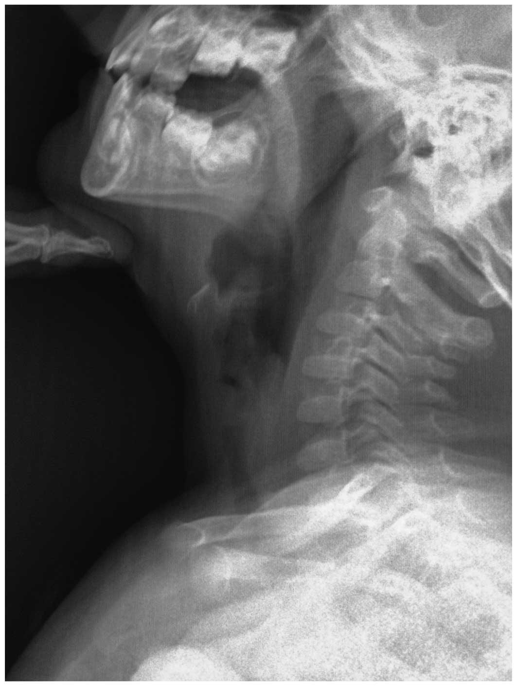 papillomatosis x ray