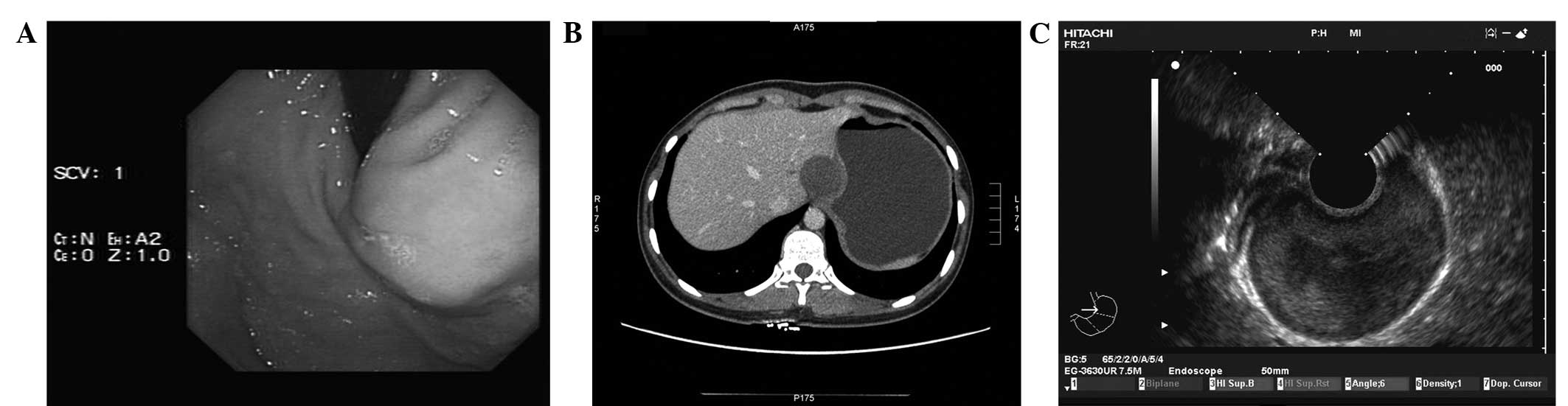 Giant Cystic Lymphangioma Originating From The Cardia Of The