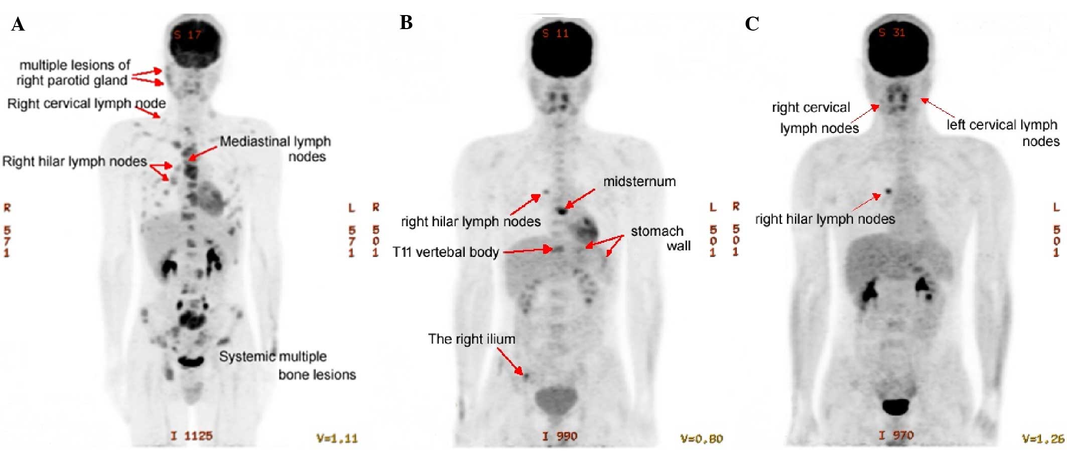 Primary Extranodal Head And Neck Classical Hodgkin Lymphoma A Rare