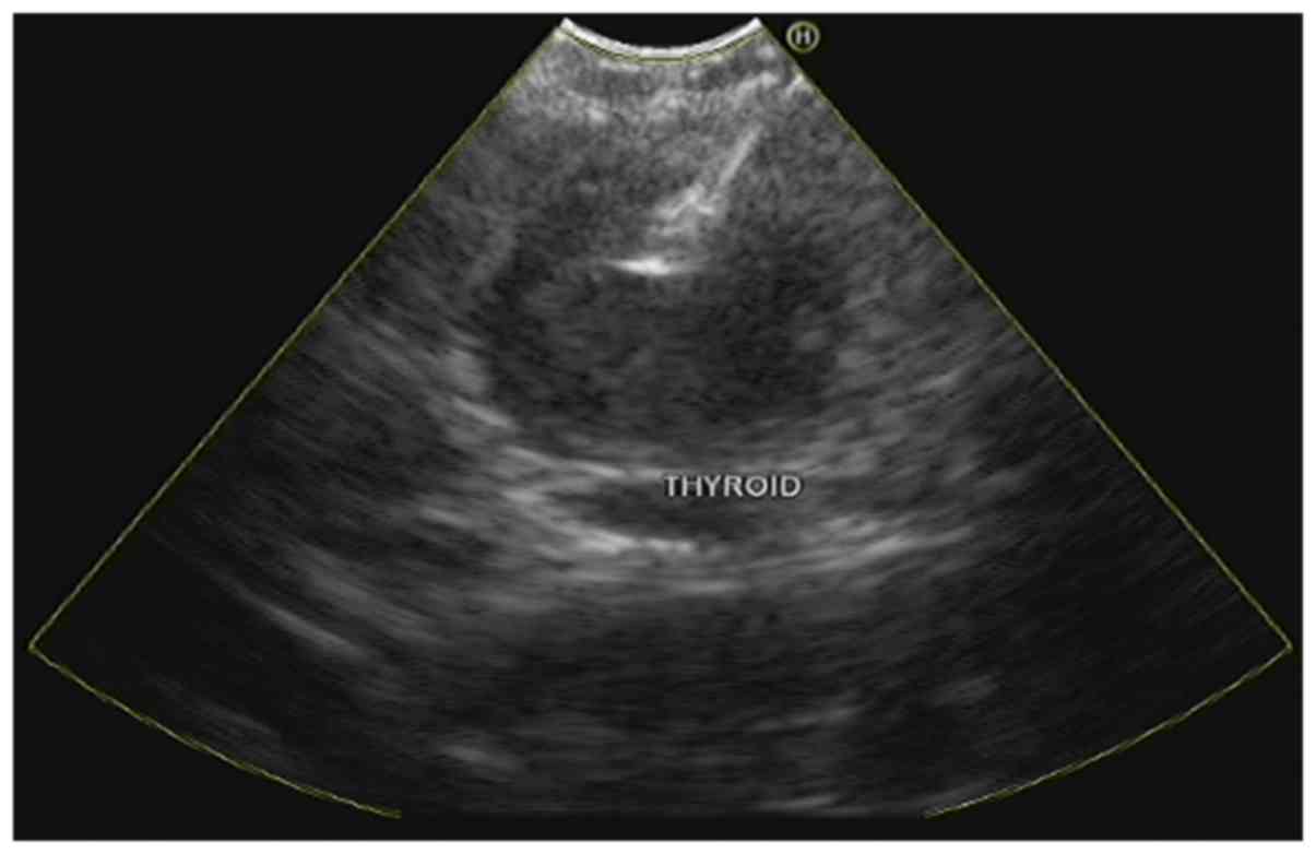 Endobronchial Ultrasound Guided Transbronchial Needle Aspiration For