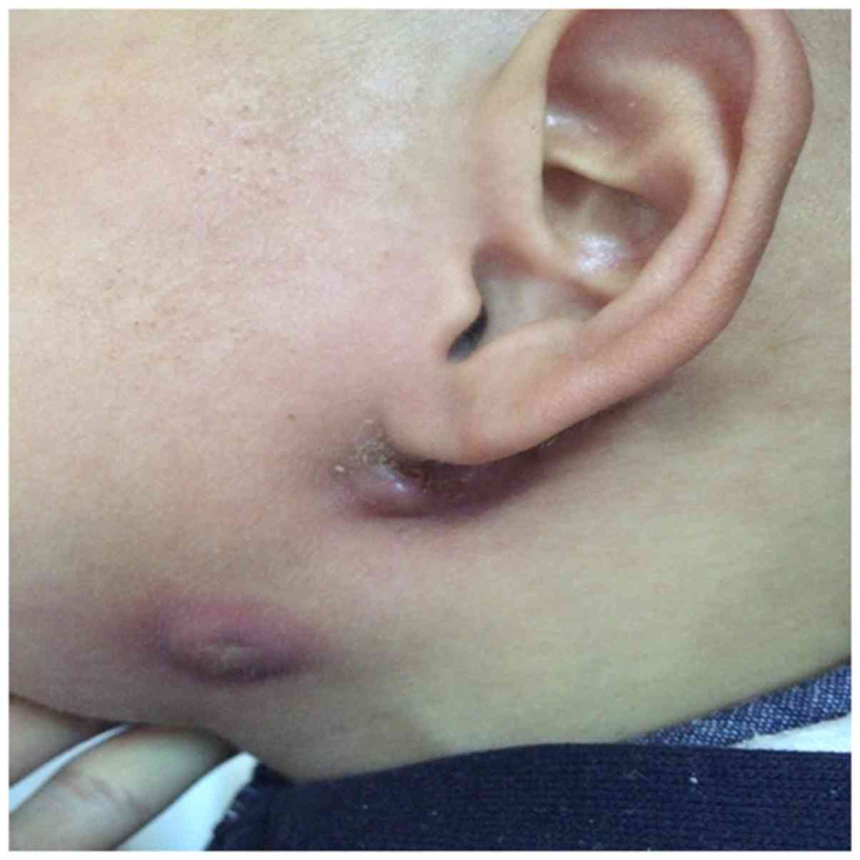 Branchial cleft cyst