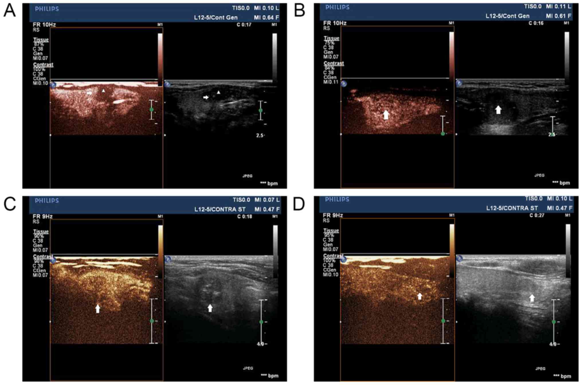Contrast‑enhanced Ultrasonography Features Of Papillary Thyroid