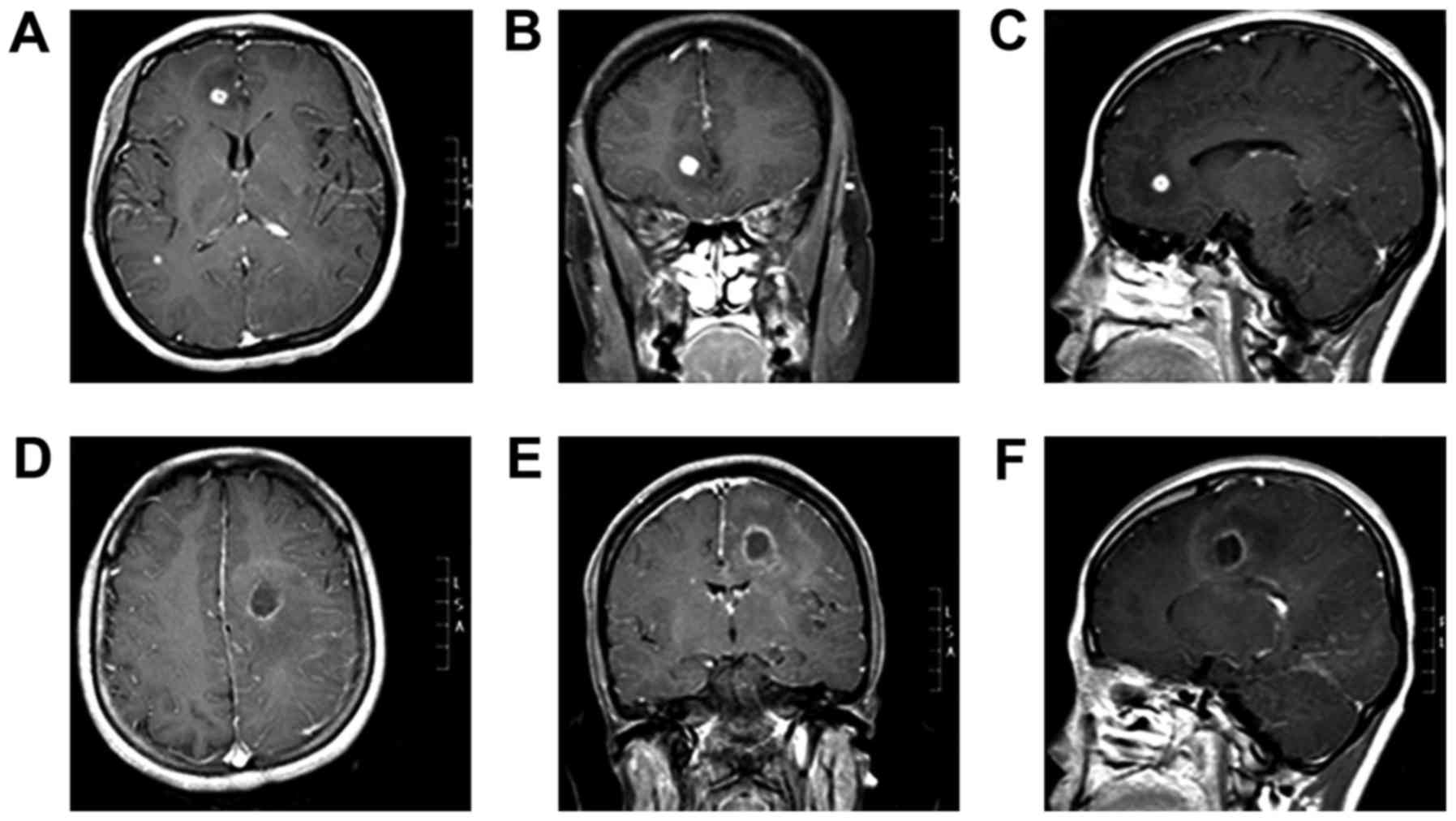 Multiple brain abscesses caused by infection with Candida glabrata: A case report1795 x 1012