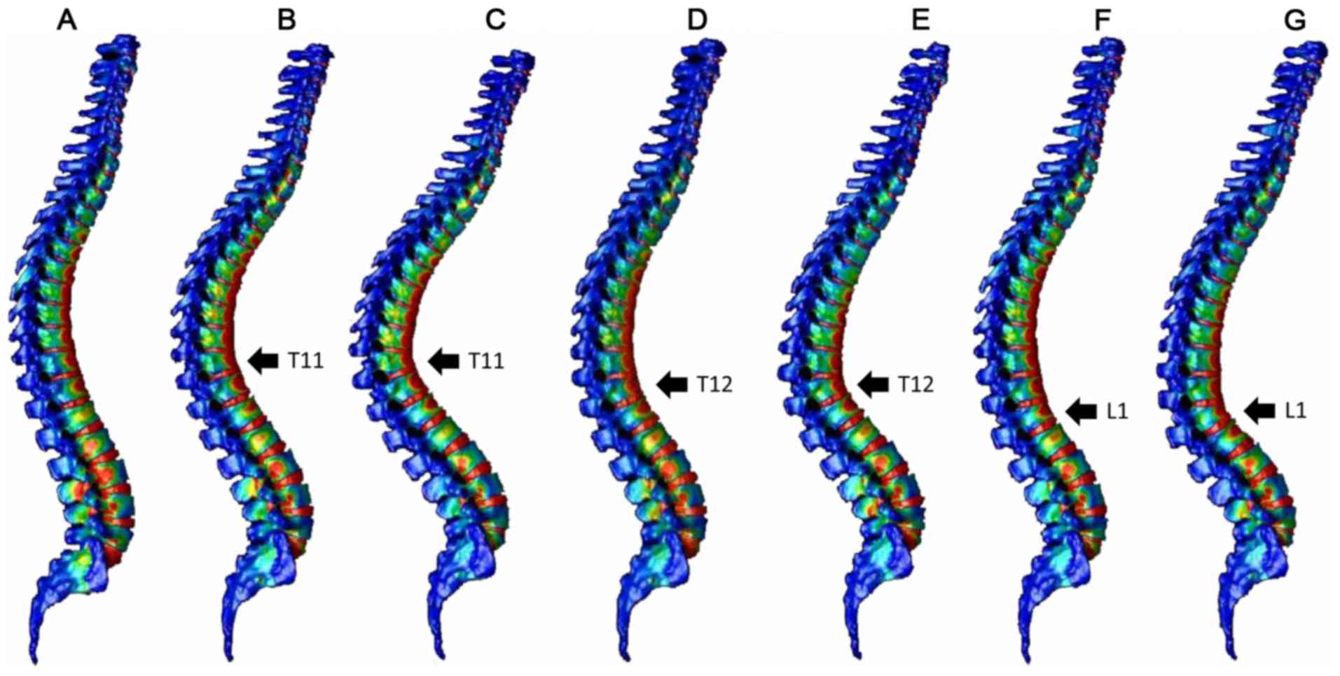 Finite element analysis of compression fractures at the thoracolumbar  junction using models constructed from medical images