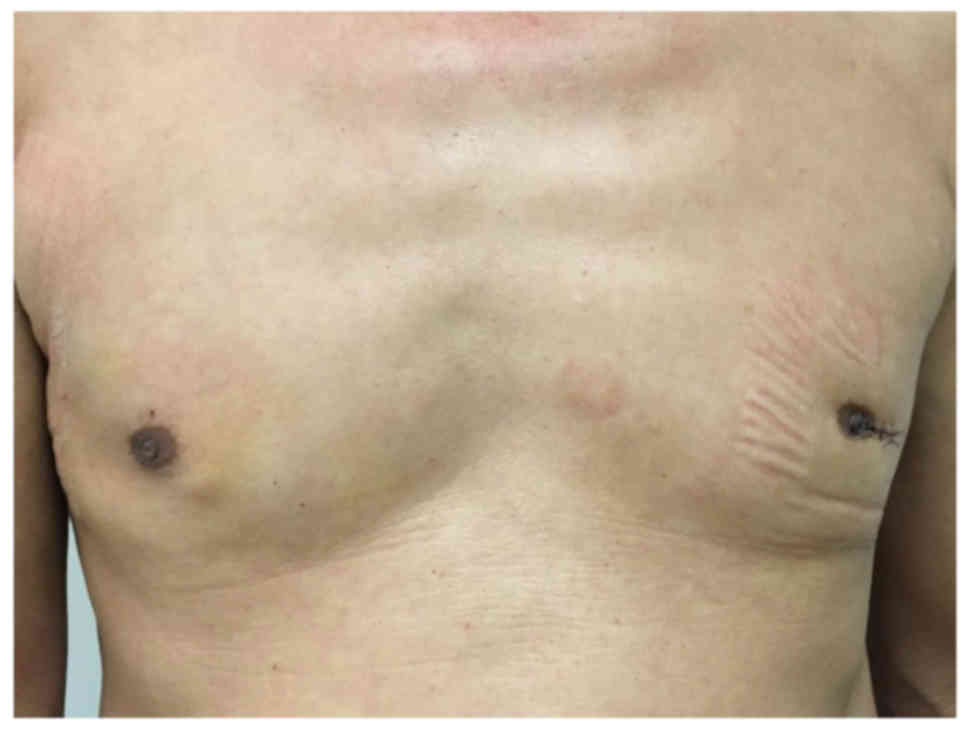 Single‑incision Surgery For Gynecomastia Using Triport A Case Report 