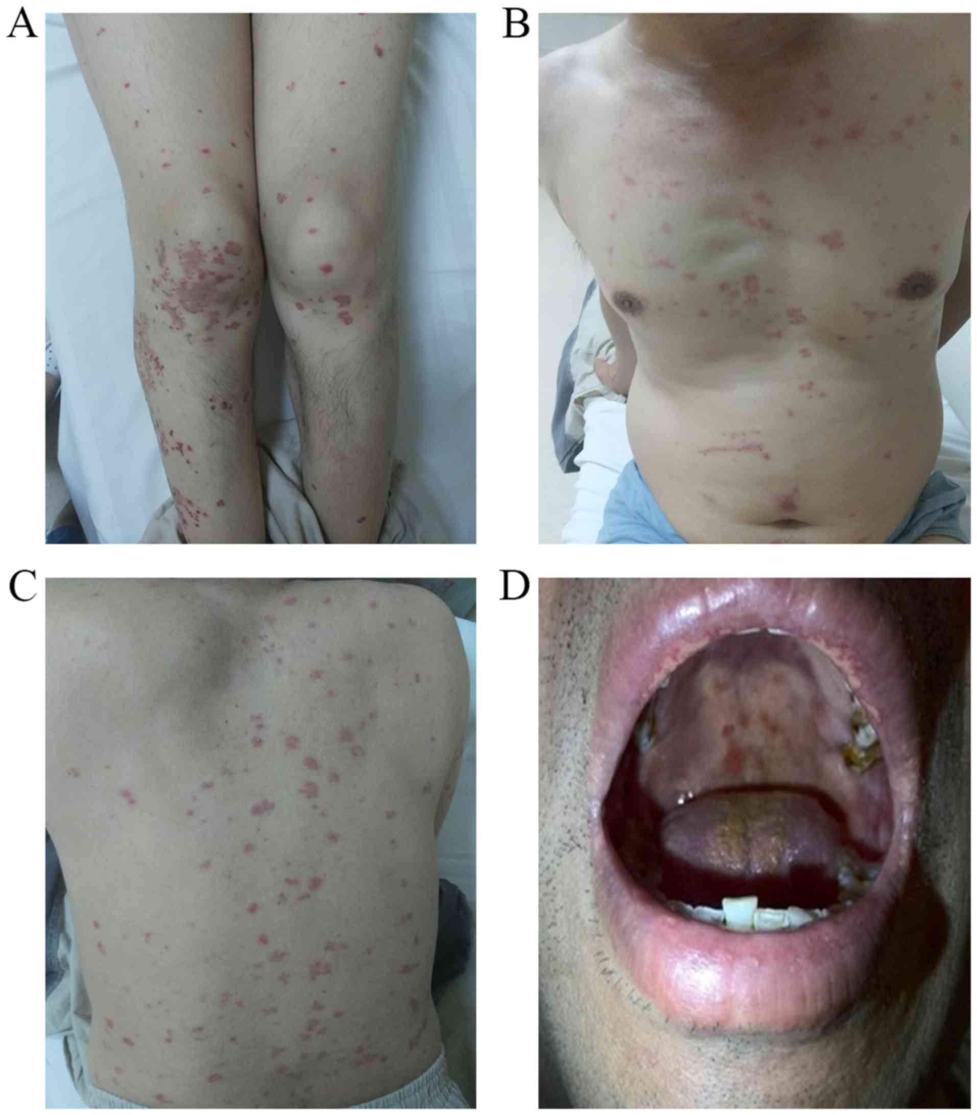 Hemophagocytic Lymphohistiocytosis Presenting With Annular Erythema