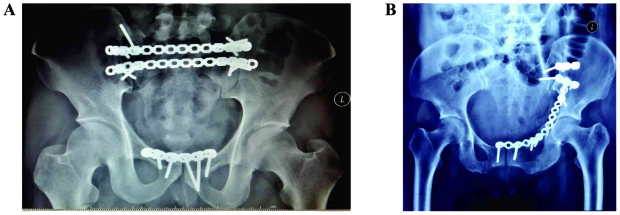Frontiers | Management of Pelvic Ring Injury Patients With Hemodynamic  Instability