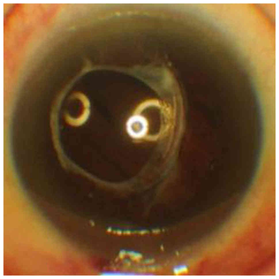 Lens Epithelium and Posterior Capsular Opacification: Prevention of PCO  with the Bag-in-the-Lens (BIL) | SpringerLink