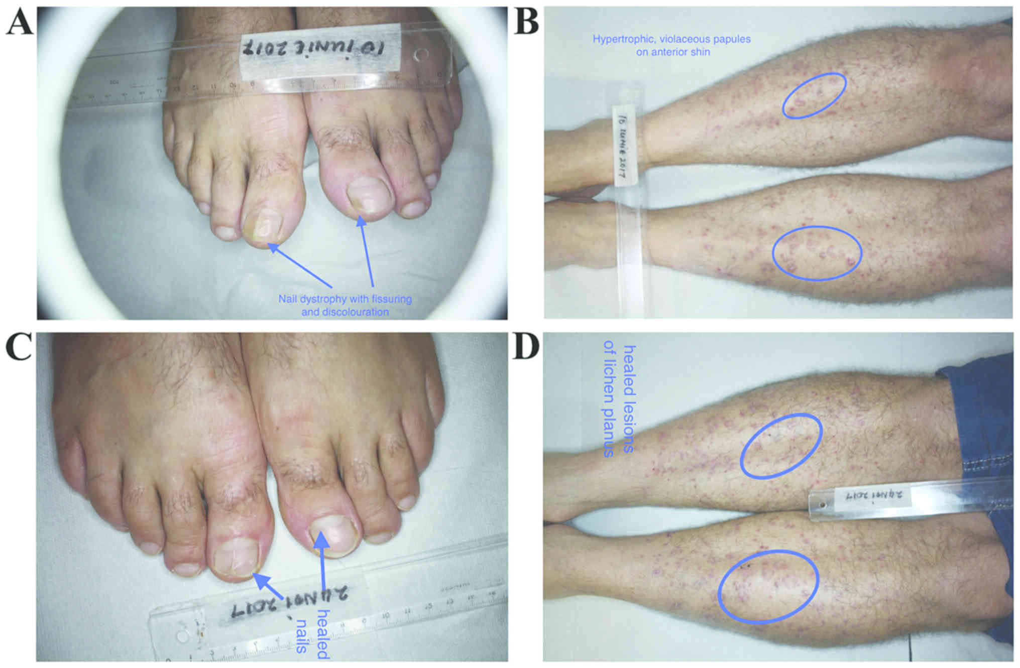 Nail lichen planus: A review of clinical presentation, diagnosis and  therapy - ScienceDirect