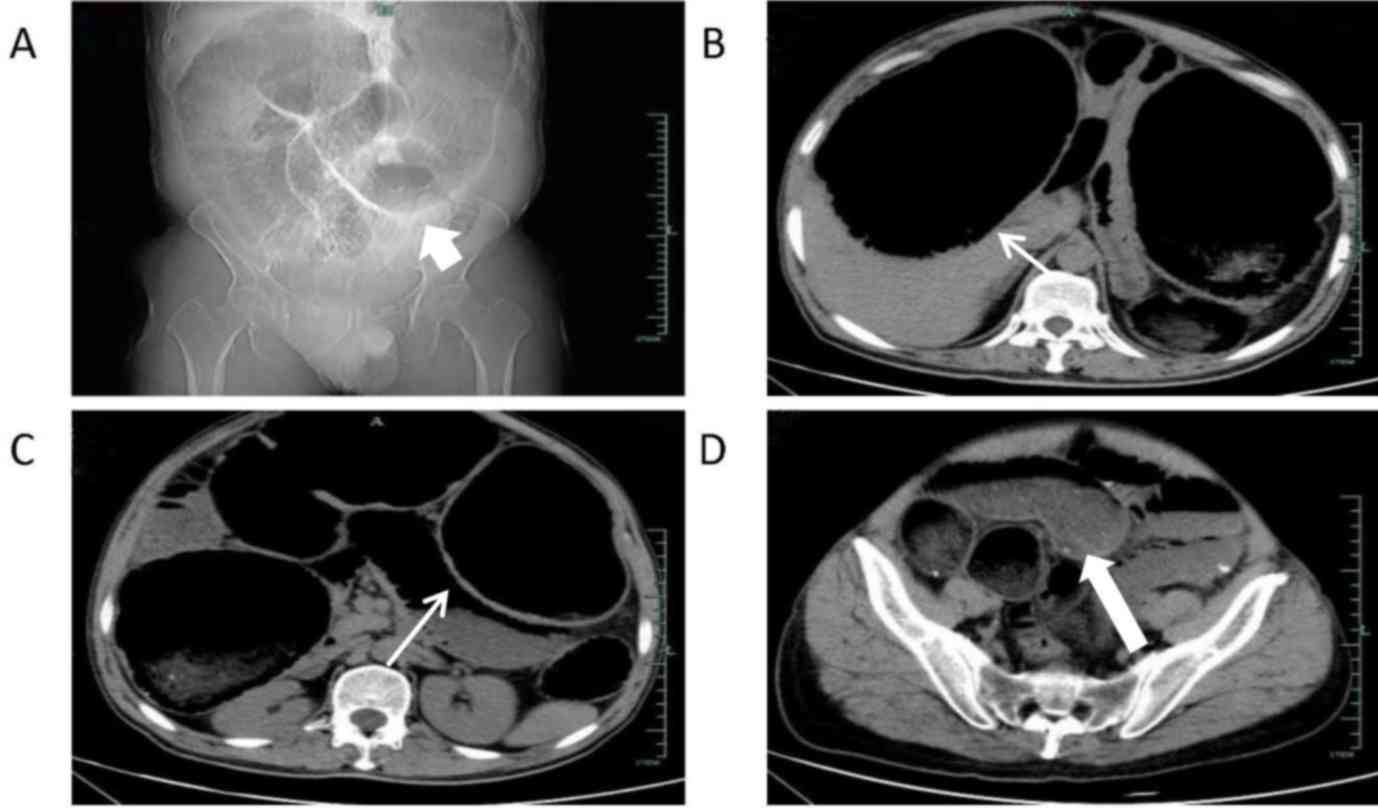 Adult congenital megacolon with acute fecal obstruction