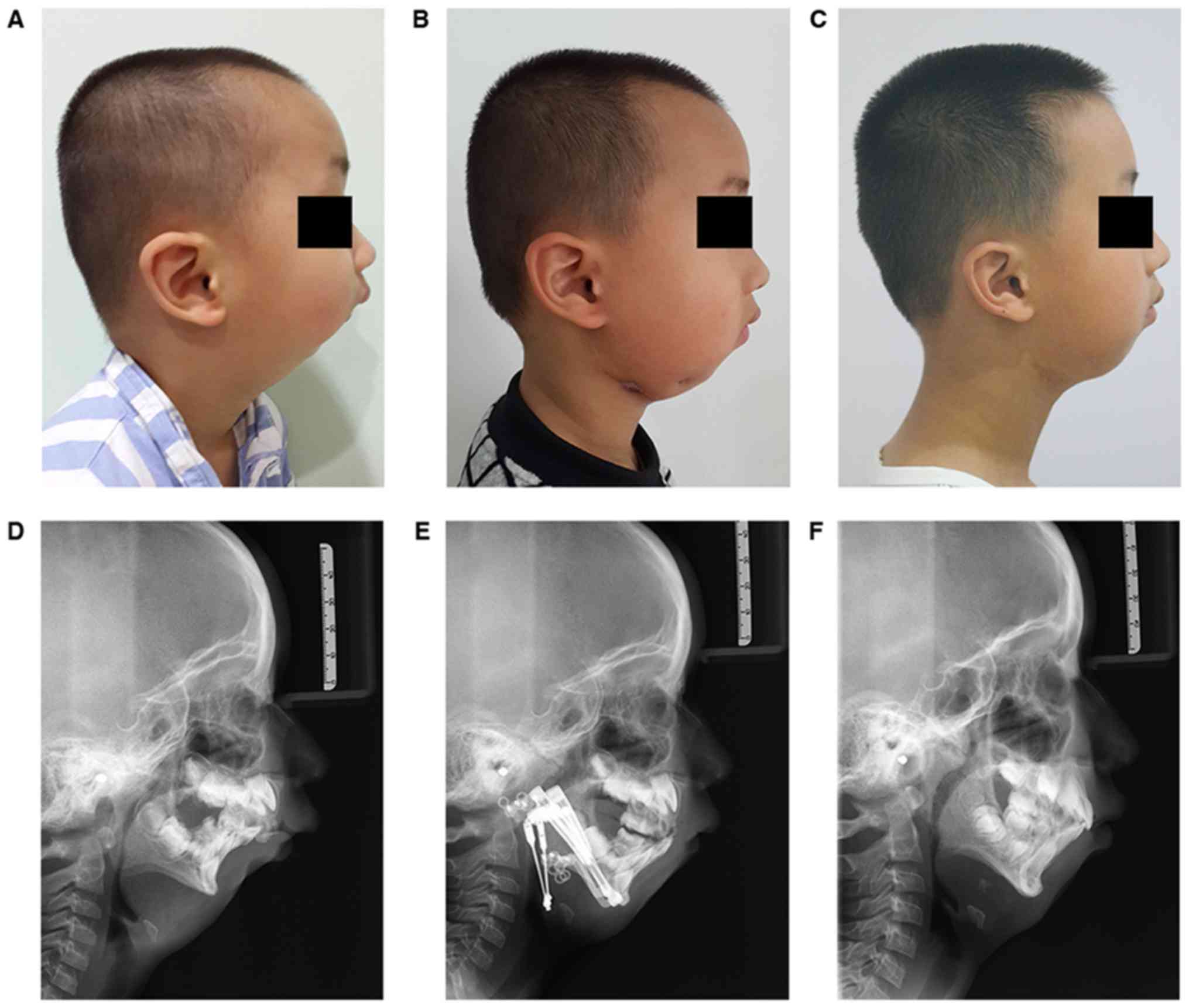 Mandibular Distraction Osteogenesis In The Treatment Of Pediatric