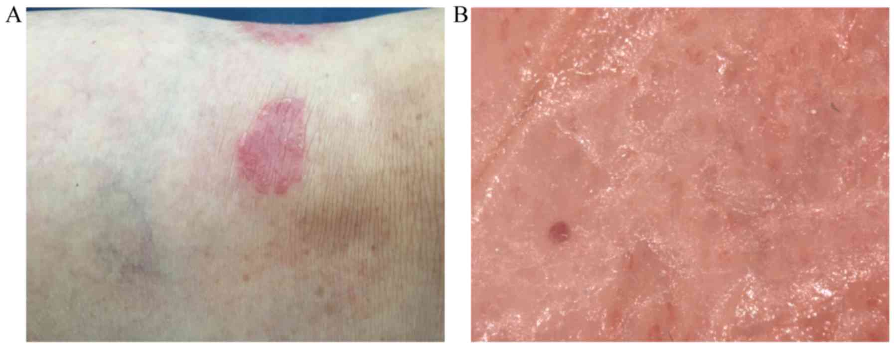 Automatic Nipple Detection Method for Digital Skin Images with Psoriasis  Lesions