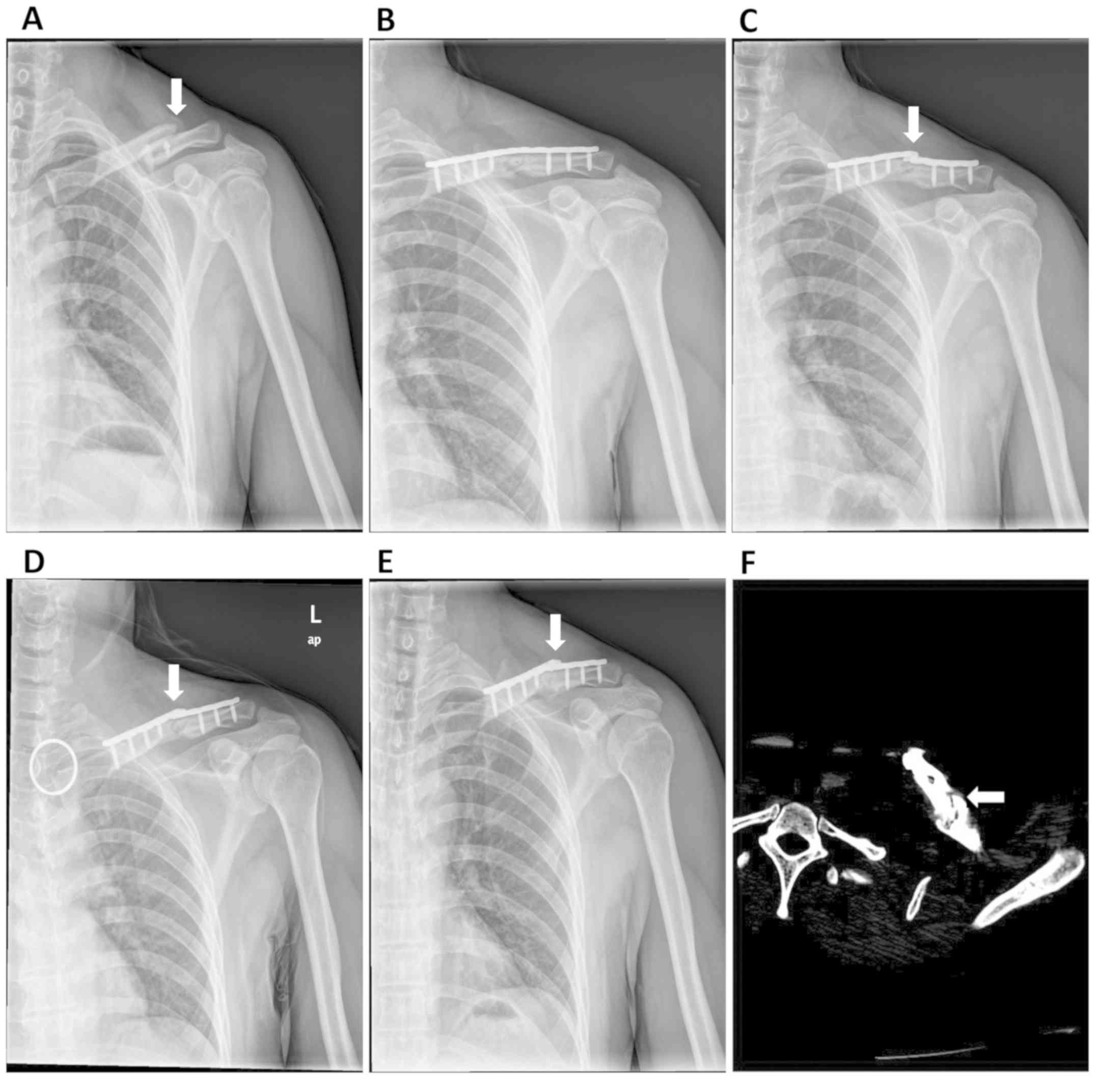 Clavicle Nonunion And Plate Breakage After Locking Compression Plate