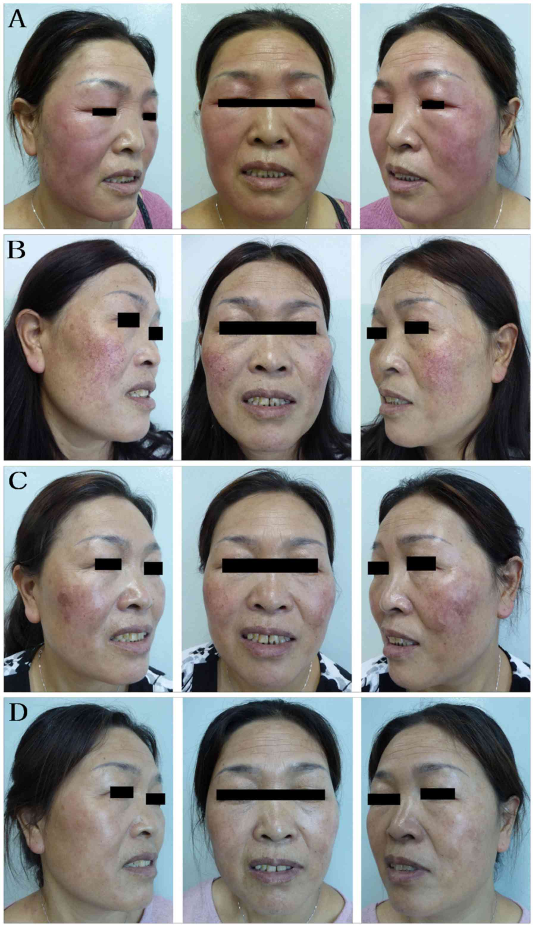 Improved telangiectasia and recurrence rate of rosacea after treatment with 540 nm‑wavelength intense pulsed light: A prospective randomized controlled trial with a follow‑up