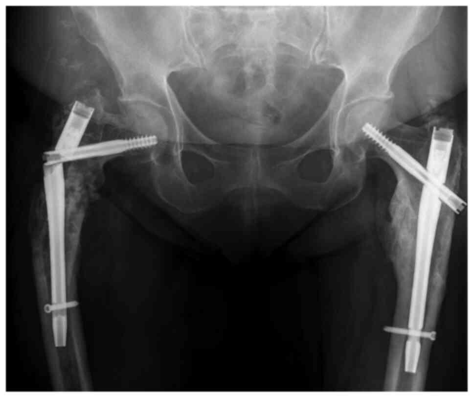 Treatment of Long Bones with a Universal Intramedullary Nail-Syst