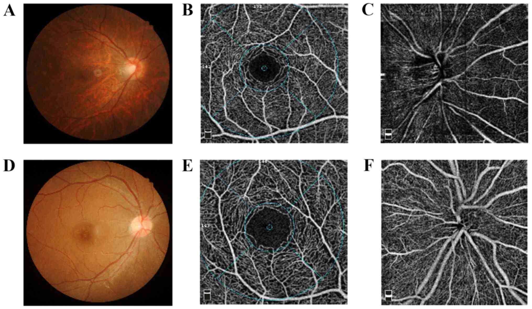 myopia retinal deformation