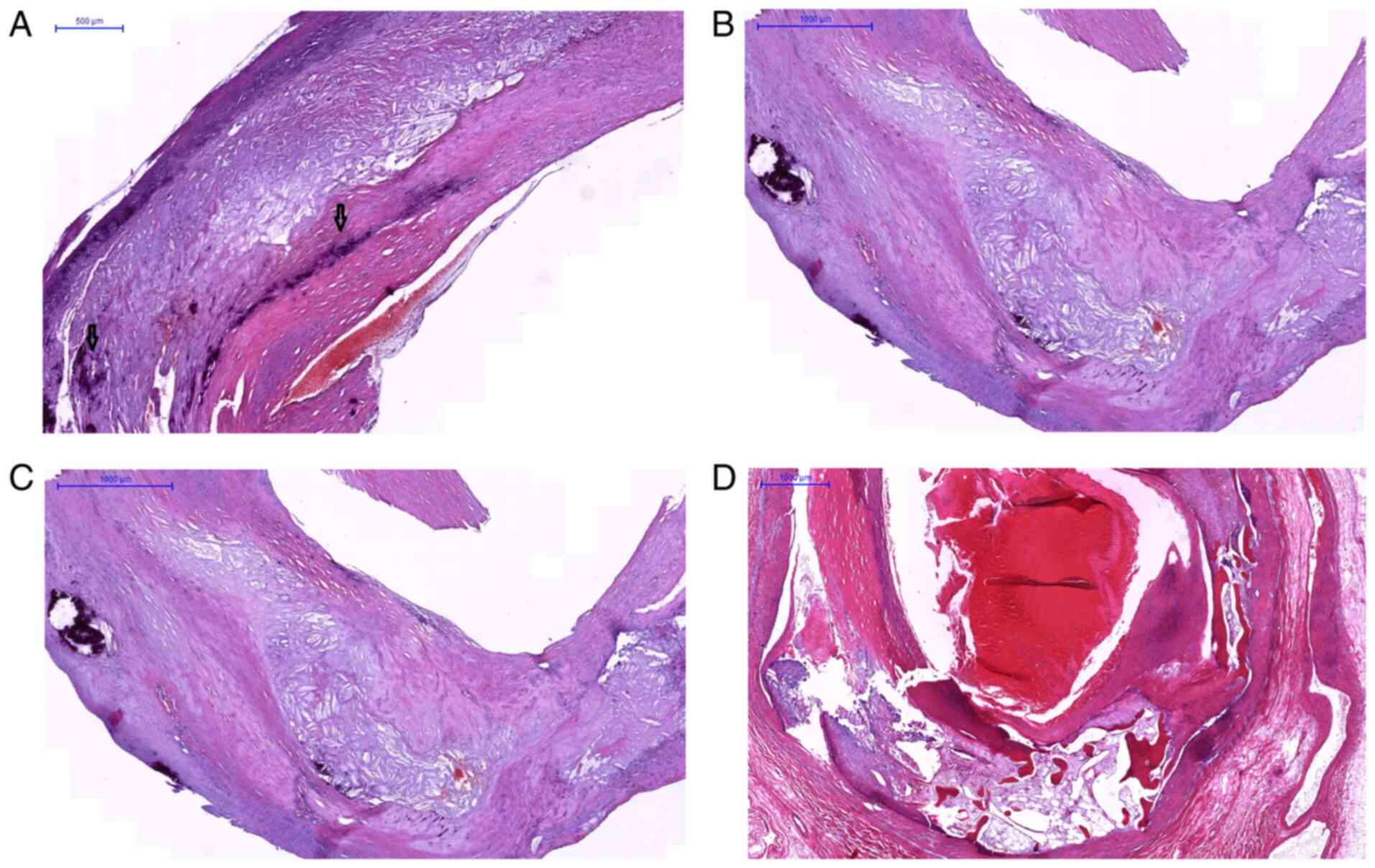 A Definition of Advanced Types of Atherosclerotic Lesions and a  Histological Classification of Atherosclerosis