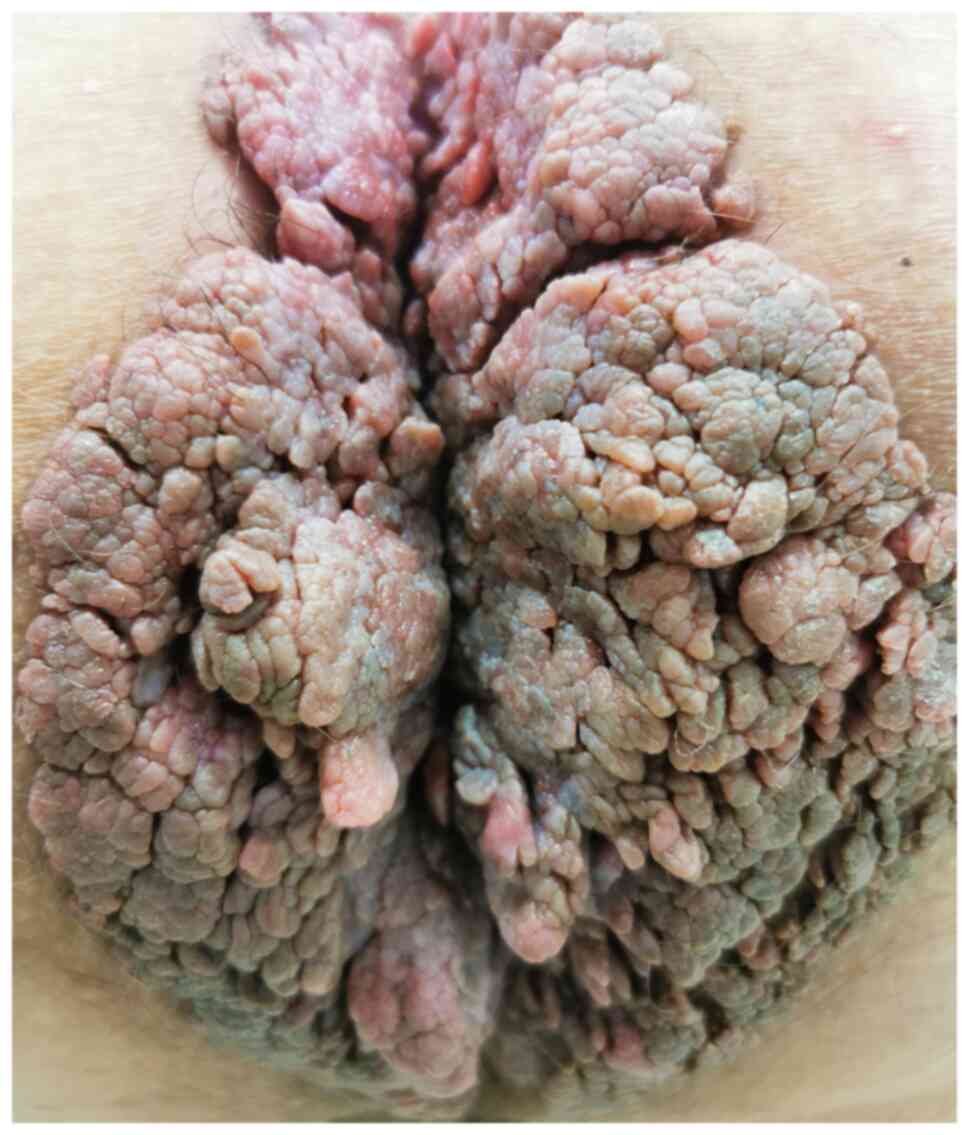 ureaplasma condyloma