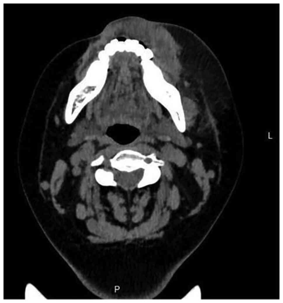 Clinical photograph showing the swelling in the mandibu