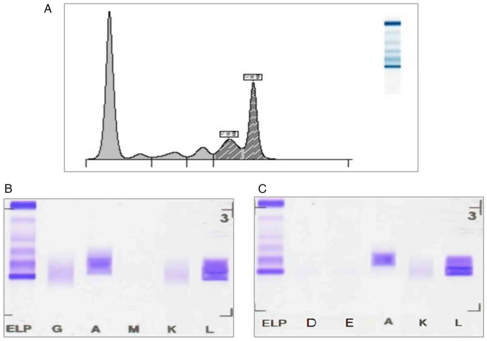 SPE and immunofixation confirming
monoclonal gammopathy. (A) SPE demonstrating an M-spike in the γ
region. (B) Immunofixation electrophoresis revealing a monoclonal
IgA λ pattern, confirming the presence of IgA-λ type multiple
myeloma. (C) Immunofixation electrophoresis further confirming the
monoclonal IgA λ pattern. AU, arbitrary units; SPE, serum protein
electrophoresis. ELP, electrophoresis reference; G, IgG; A, IgA; M,
IgM; K, κ light chain; L, λ light chain; D, IgD; E, IgE.