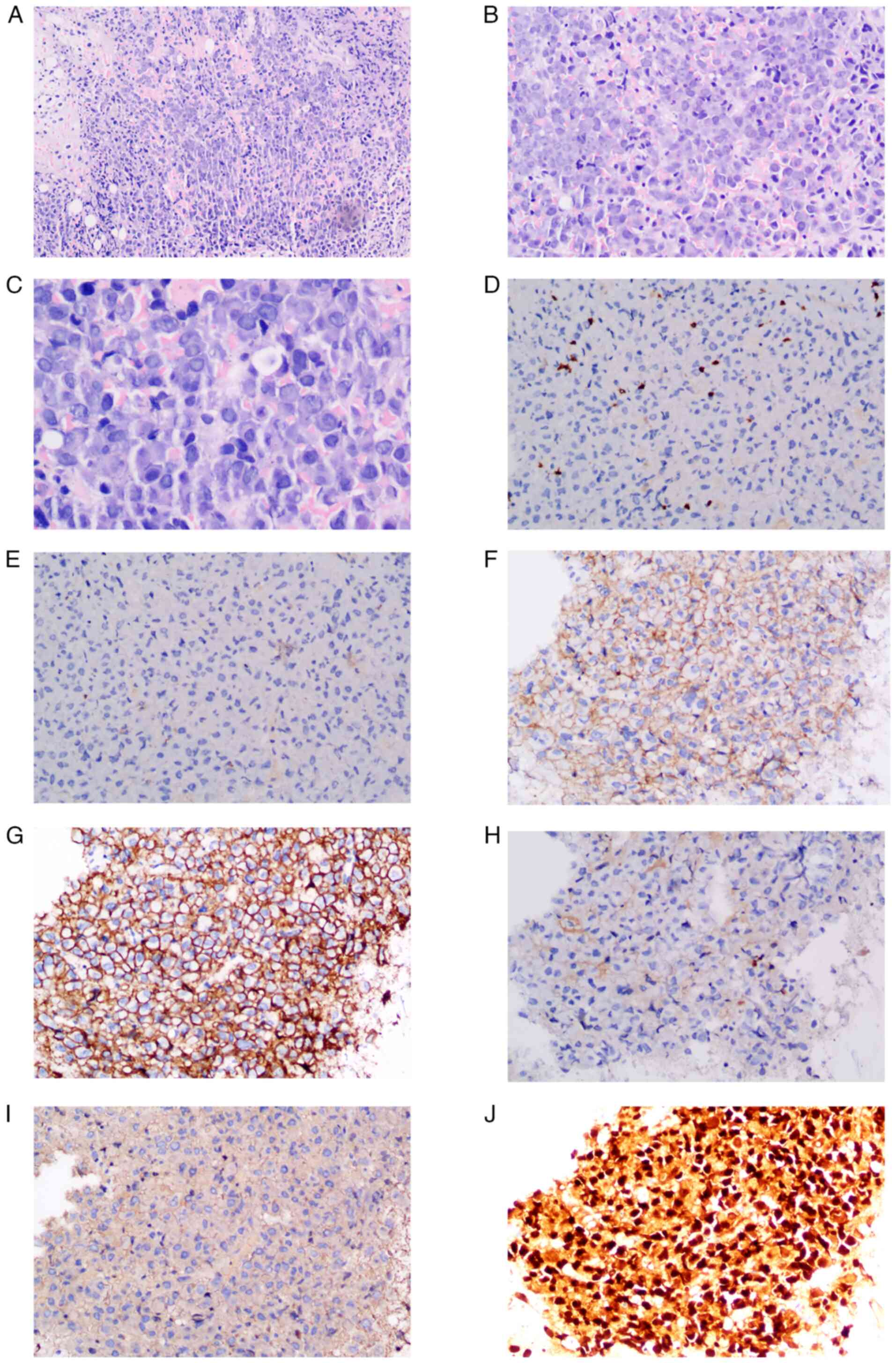 Immunohistochemical characterization
of bone marrow biopsy. (A) Congo red staining showed amyloid
deposits with birefringence under polarized light, confirming
amyloidosis. (B) Scattered CD3+ T cells. (C)
CD20+ B cells. (D) Diffuse CD56 positivity indicating
natural killer cell involvement. (E) Diffuse CD138 staining marking
plasma cell infiltration. (F) Negative κ light chain staining. (G)
Diffuse positive staining of λ light chains, confirming
monoclonality. (H) Multiple myeloma oncogene 1-positivity indicated
plasma cell differentiation. (I) Hematoxylin and eosin staining
revealed diffuse infiltration by atypical lymphoid/plasma cells.
(J) Positive staining for amyloid deposits in bone marrow biopsy.
All images were captured under a light microscope at x400
magnification.